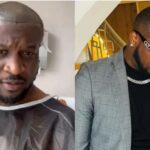 hair transplant cost london