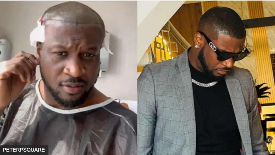 hair transplant cost london